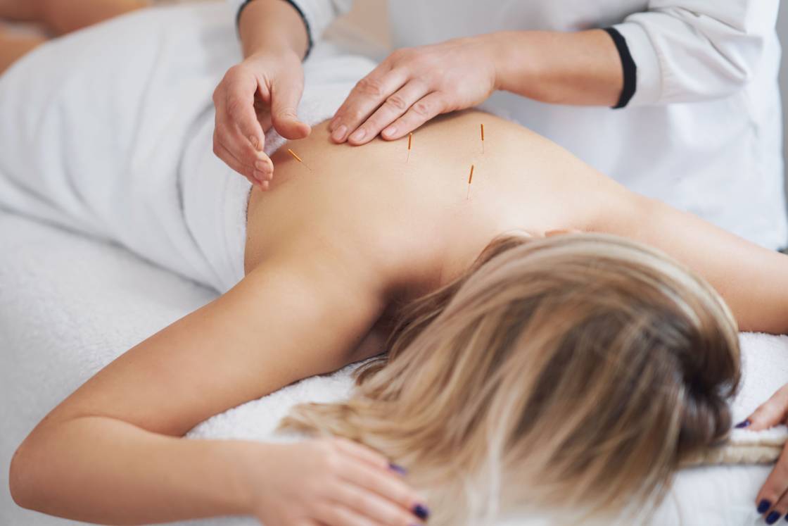 Acupuncture